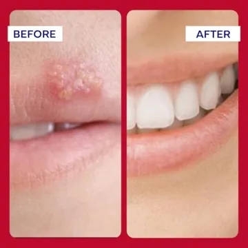 EMUAIDMAX Ointment for Itchy Skin Relief Treatment