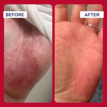 EMUAIDMAX Ointment for Itchy Skin Relief Treatment