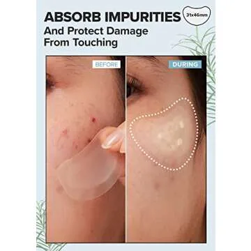 I DEW CARE Hydrocolloid Acne Pimple Patch - Timeout Blemish Chin & Cheeks | Korean zit Dark Spot Patches for face and skin, Pus absorbing with Tea Tree Leaf Oil, Trouble Remover, 9 Count