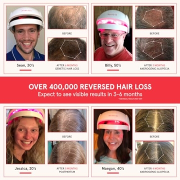 iRestore Laser Hair Growth System for Men and Women - FDA Cleared