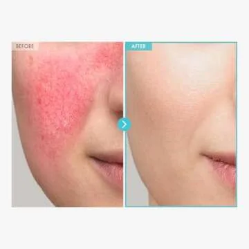 Heal and Soothe with TOSOWOONG Zinc Cream