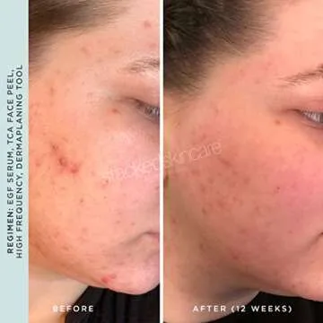 High Frequency Wand for Acne Treatment and Pore Cleansing
