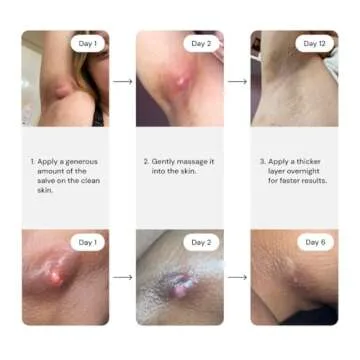 Universal Flare Care | Relief for 97% of Skin Issues | Cysts, Inflamed Skin, Hidradenitis Suppurativa, Abscesses, Impetigo | All Natural Flare Up Solution With Propolis & Egg Yolk Extract 4 oz