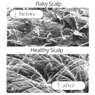 RAUSCH Coltsfoot Anti-Dandruff Shampoo 200 ml - Powerful Scalp Therapy