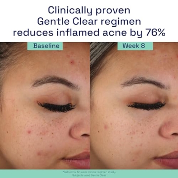 Cetaphil Mattifying Acne Moisturizer for Sensitive Skin