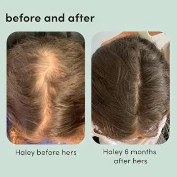hers Topical Minoxidil Solution, 2% - Hair Growth Treatment for Women - Clinically Proven to Reduce Hair Loss in 3-6 Months - Unscented, 2 Pack