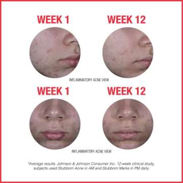 Neutrogena Stubborn Acne AM Face Treatment with Benzoyl Peroxide, 2.0 oz & Stubborn Marks PM Treatment with Retinol SA, 1 fl. oz