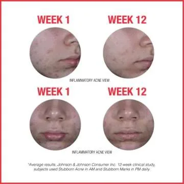 Neutrogena Stubborn Acne AM Face Treatment with Benzoyl Peroxide, 2.0 oz & Stubborn Marks PM Treatment with Retinol SA, 1 fl. oz