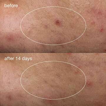 Dermalogica Deep Acne Liquid Patch, Invisible Spot Treatment for Pimple and Blemishes, Liquid to Patch Type Skin Soothing Clearing and Preventing Breakouts, Sulfur Based - 0.5 fl oz