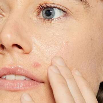 Dermalogica Deep Acne Liquid Patch, Invisible Spot Treatment for Pimple and Blemishes, Liquid to Patch Type Skin Soothing Clearing and Preventing Breakouts, Sulfur Based - 0.5 fl oz