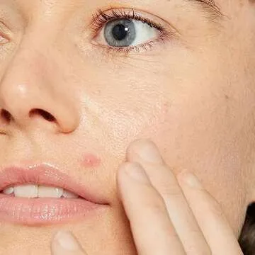 Dermalogica Deep Acne Liquid Patch, Invisible Spot Treatment for Pimple and Blemishes, Liquid to Patch Type Skin Soothing Clearing and Preventing Breakouts, Sulfur Based - 0.5 fl oz